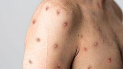 money pox Symptoms, causes, prevention and everything you need to know