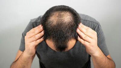 Ayurveda Remedies for Bald Patches- బట్టతల ప్యాచెస్