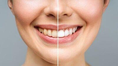  Teeth Whitening Tips