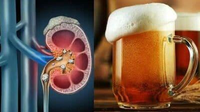 Beer for Kidney Stones