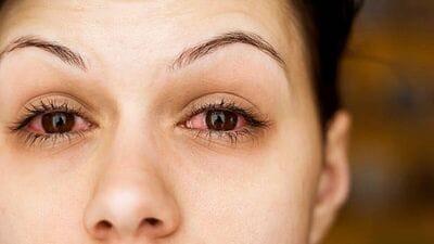 Preventing Pink Eye: 